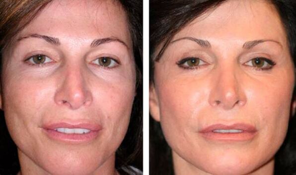 pictures before after plasma facial skin rejuvenation