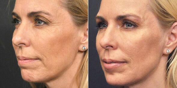 pictures before and after plasma rejuvenation