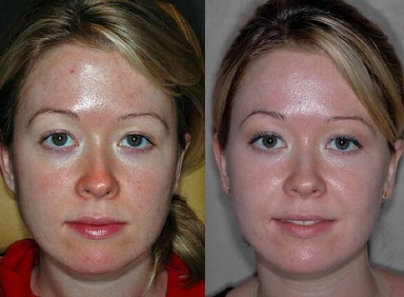 pictures before and after the plasma rejuvenation procedure