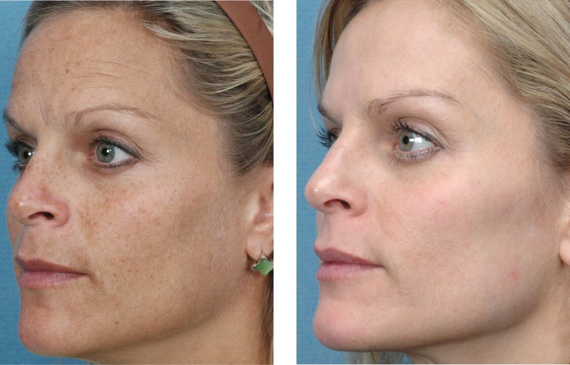 skin rejuvenation photos before and after 1