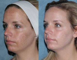 Photo before and after fractional skin rejuvenation facial