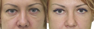 Photos before and after eyelid contours