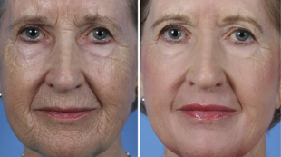 fractional facial rejuvenation before and after pictures