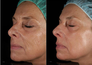 Laser skin rejuvenation before and after