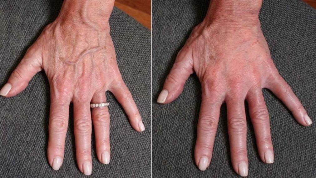 contour plastic, hand rejuvenation photos 1 before and after